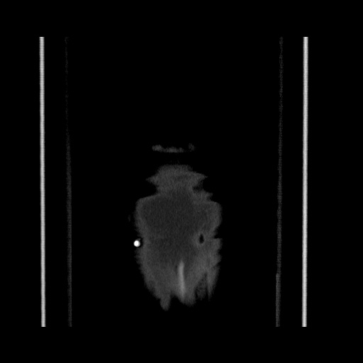 Acute cholecystitis with tensile fundus sign (Radiopaedia 71394-81723 Coronal non-contrast 131).jpg