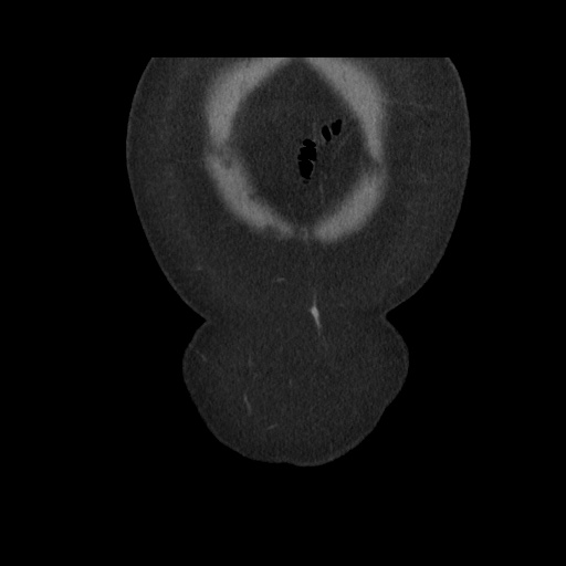 Acute cholecystitis with tensile fundus sign (Radiopaedia 71394-81723 Coronal non-contrast 20).jpg