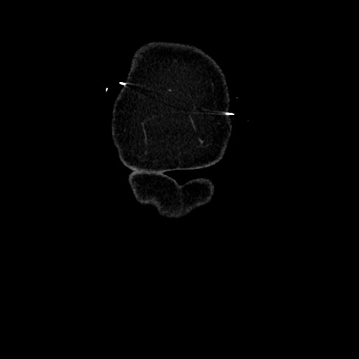 Acute diverticulitis - transverse colon (Radiopaedia 87063-103327 Coronal C+ portal venous phase 13).jpg