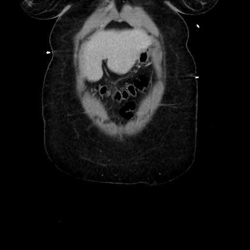 Acute diverticulitis - transverse colon (Radiopaedia 87063-103327 Coronal C+ portal venous phase 41).jpg