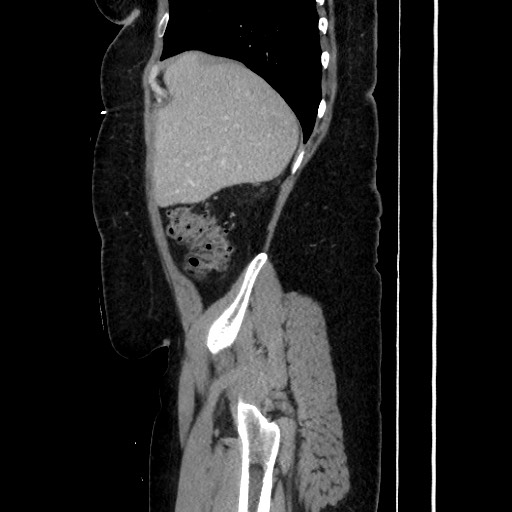 Acute diverticulitis - transverse colon (Radiopaedia 87063-103327 Sagittal C+ portal venous phase 69).jpg