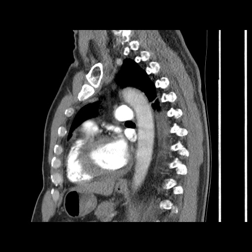 Acute epicardial fat necrosis (Radiopaedia 42327-45440 Sagittal C+ CTPA 44).jpg