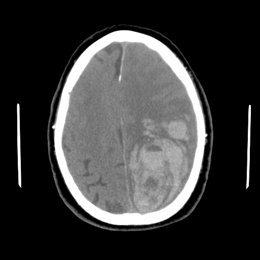 Acute hemorrhagic stroke (Radiopaedia 17507-17223 Axial non-contrast 38).jpg