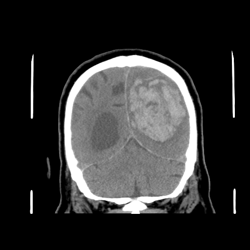 Acute hemorrhagic stroke (Radiopaedia 17507-17223 Coronal non-contrast 42).jpg