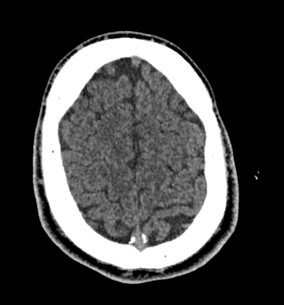 Acute ischemic stroke - posterior circulation territory (Radiopaedia 77670-89881 non-contrast 76).jpg