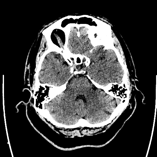 File:Acute left middle cerebral artery territory ischemic stroke (Radiopaedia 35688-37223 Axial non-contrast 20).png
