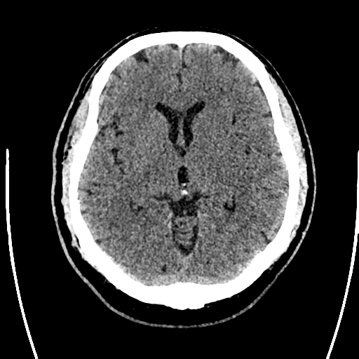 Acute left middle cerebral artery territory ischemic stroke (Radiopaedia 35688-37223 Axial non-contrast 37).png
