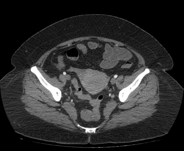 Acute mesenteric ischemia (Radiopaedia 80029-93316 Axial C+ arterial phase 111).jpg