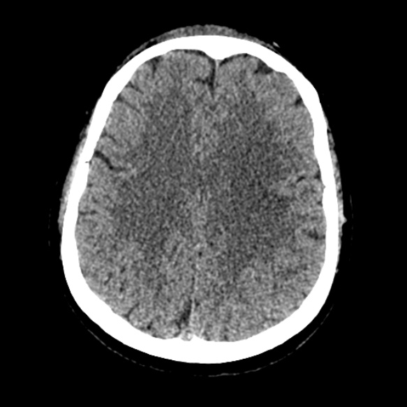 Acute middle cerebral artery territory infarct (Radiopaedia 52380-58283 Axial non-contrast 70).jpg