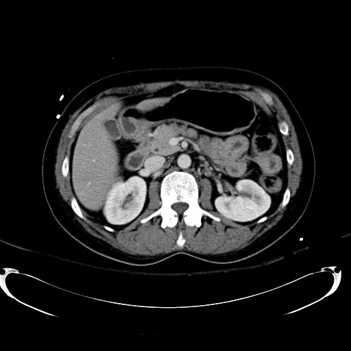 File:Acute myocardial infarction in CT (Radiopaedia 39947-42415 Axial C+ portal venous phase 48).jpg