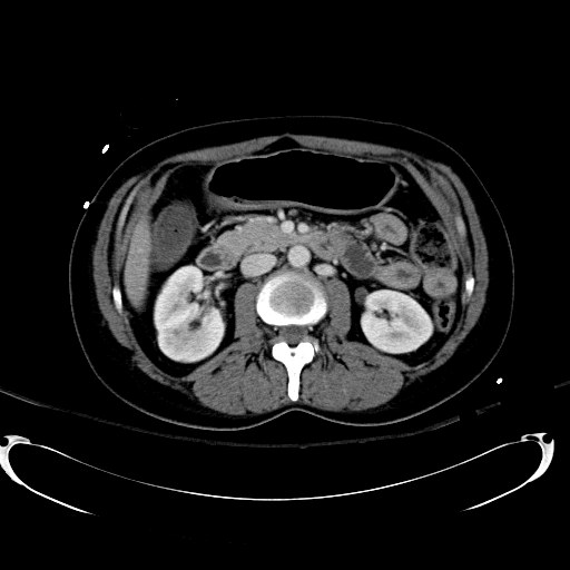 File:Acute myocardial infarction in CT (Radiopaedia 39947-42415 Axial C+ portal venous phase 55).jpg