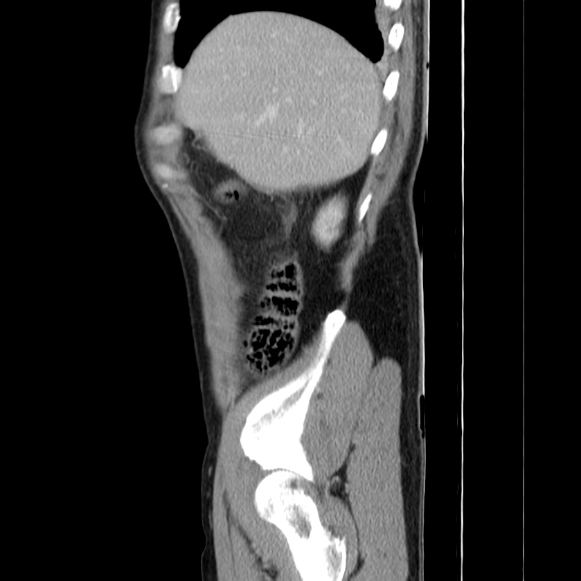 Acute pancreatitis (Radiopaedia 22572-22596 Sagittal C+ portal venous phase 10).jpg