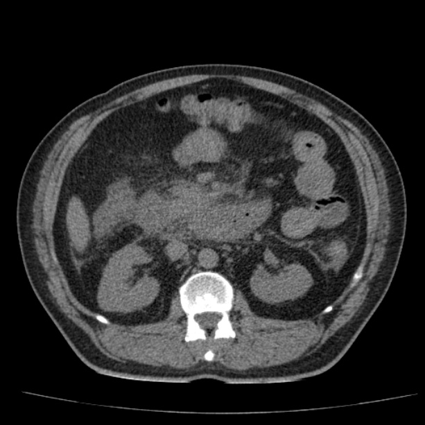 Acute pancreatitis (Radiopaedia 26663-26813 Axial non-contrast 45).jpg