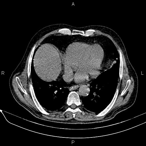 File:Acute pancreatitis (Radiopaedia 85146-100701 Axial non-contrast 14).jpg