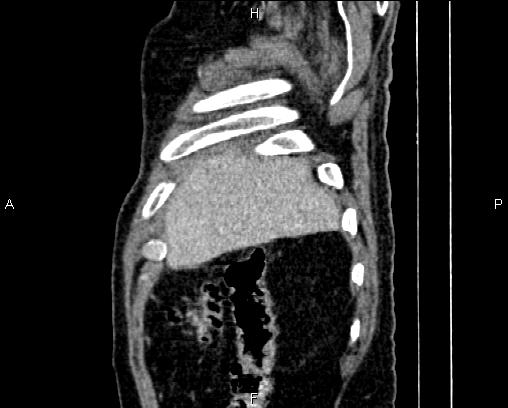 Acute pancreatitis (Radiopaedia 85146-100701 Sagittal C+ portal venous phase 9).jpg