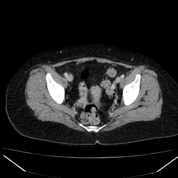 Acute pancreatitis - Balthazar C (Radiopaedia 26569-26714 Axial C+ portal venous phase 84).jpg