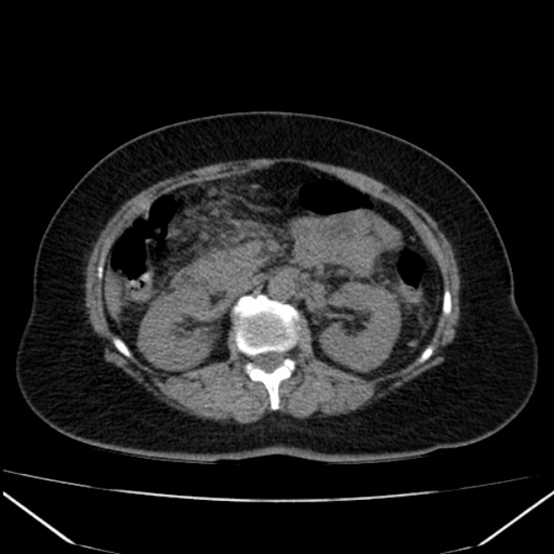 Acute pancreatitis - Balthazar C (Radiopaedia 26569-26714 Axial non-contrast 41).jpg