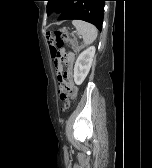 Acute pancreatitis - Balthazar E - post ERCP (Radiopaedia 27562-27772 Sagittal C+ portal venous phase 107).png