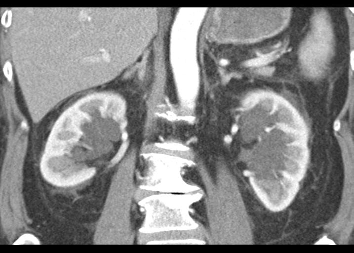 Acute pancreatitis and walled-off necrosis (Radiopaedia 29888-30403 Coronal C+ portal venous phase 36).jpg