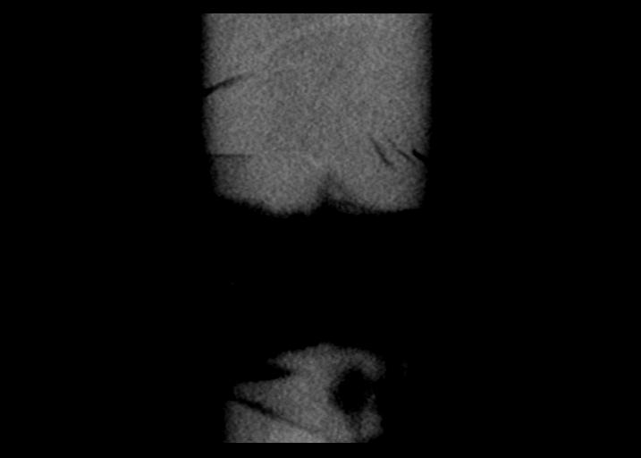 File:Acute pancreatitis and walled-off necrosis (Radiopaedia 29888-30403 Coronal C+ portal venous phase 56).jpg