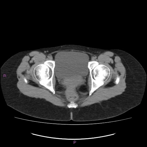 Acute pancreatitis secondary to stone at minor papilla and pancreatic divisum (Radiopaedia 76570-88333 Axial non-contrast 75).jpg