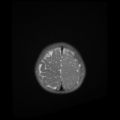 File:Acute phase of hemiconvulsion-hemiplegia epilepsy syndrome (Radiopaedia 29309-29745 Axial T2 4).jpg