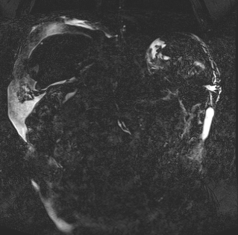 Acute portal vein thrombosis (Radiopaedia 73198-83925 Coronal Heavily T2 thin cuts 61).jpg