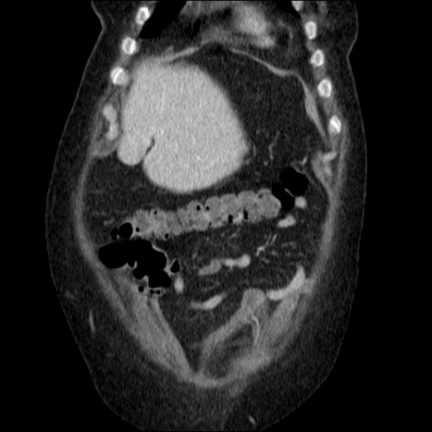 Acute pyelonephritis (Radiopaedia 26584-26729 C+ portal venous phase 16).jpg