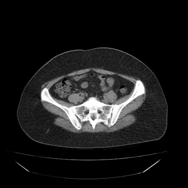 Acute pyelonephritis (Radiopaedia 33397-34434 Axial non-contrast 59).jpg