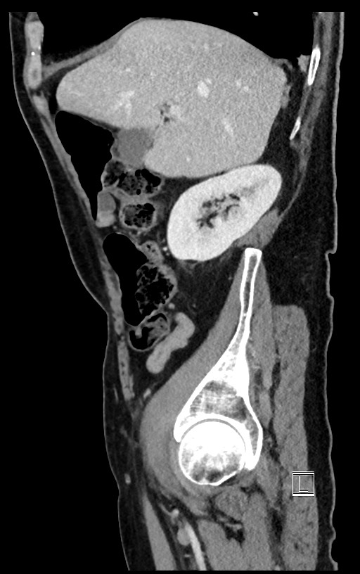 Acute renal infarction (Radiopaedia 59375-66736 Sagittal C+ portal venous phase 44).jpg