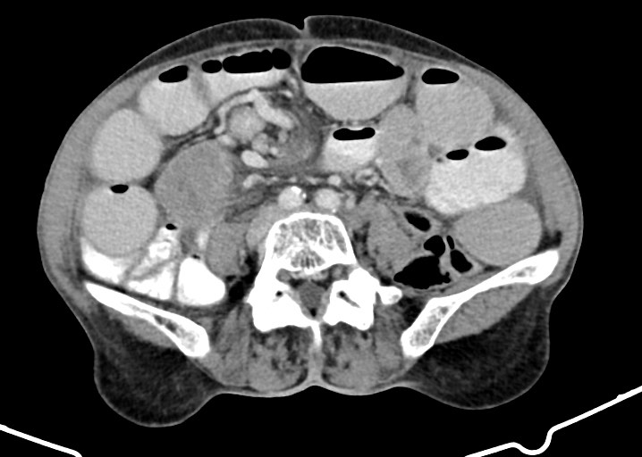 Acute small bowel (ileal) volvulus (Radiopaedia 71740-82139 Axial C+ portal venous phase 128).jpg