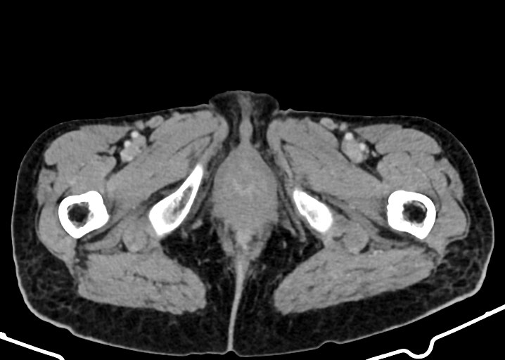 Acute small bowel (ileal) volvulus (Radiopaedia 71740-82139 Axial C+ portal venous phase 217).jpg