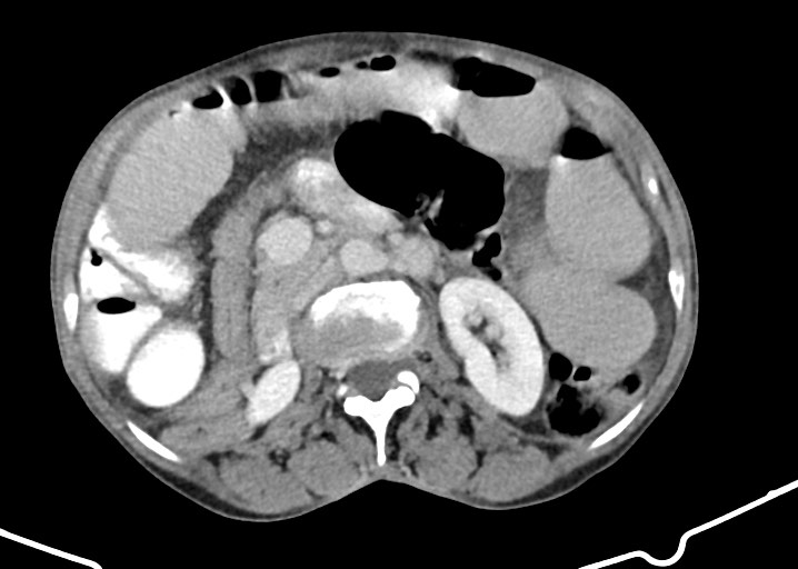 File:Acute small bowel (ileal) volvulus (Radiopaedia 71740-82139 Axial C+ portal venous phase 90).jpg