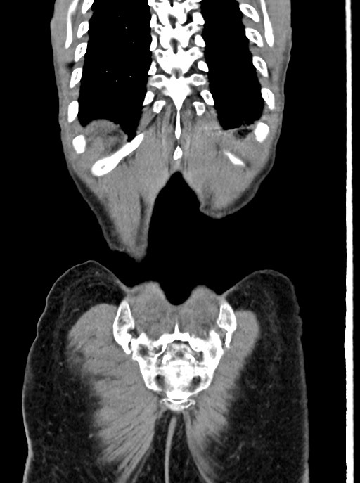 Acute small bowel (ileal) volvulus (Radiopaedia 71740-82139 Coronal C+ portal venous phase 102).jpg