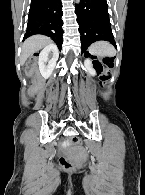 Acute small bowel (ileal) volvulus (Radiopaedia 71740-82139 Coronal C+ portal venous phase 88).jpg