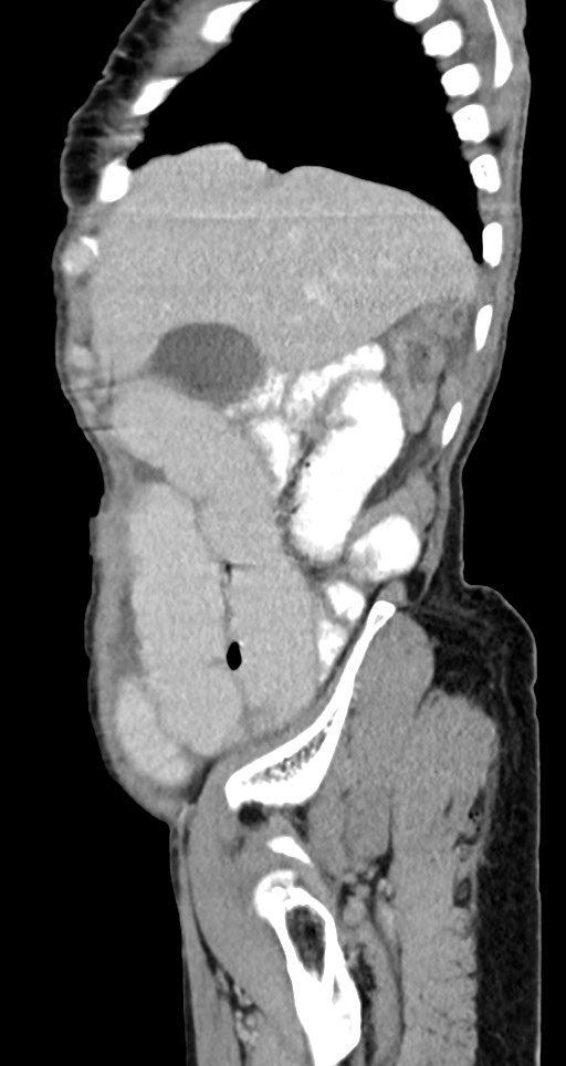 Acute small bowel (ileal) volvulus (Radiopaedia 71740-82139 Sagittal C+ portal venous phase 131).jpg