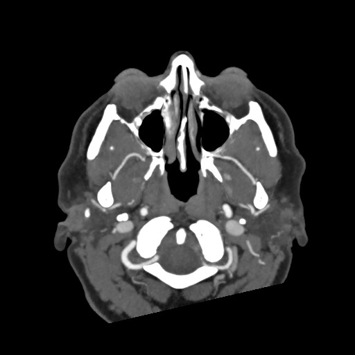 Acute subarachnoid hemorrhage and accessory anterior cerebral artery (Radiopaedia 69231-79009 D 6).jpg
