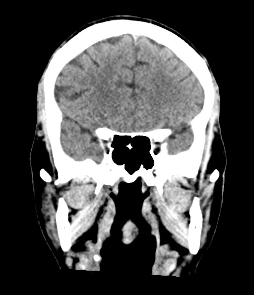 Acute superior cerebellar artery territory infarct (Radiopaedia 84104-99359 Coronal non-contrast 38).jpg