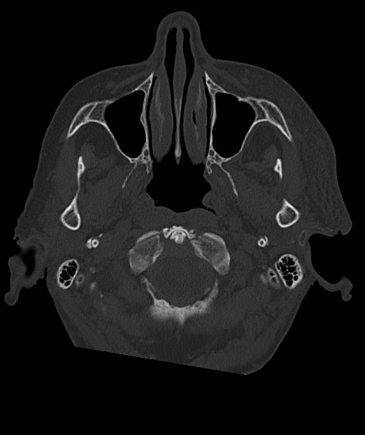 Acute traumatic subdural hematoma (Radiopaedia 82921-97257 Axial bone window 97).jpg