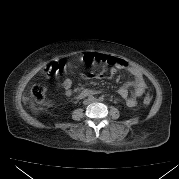 Acute tubular necrosis (Radiopaedia 28077-28334 Axial non-contrast 41).jpg