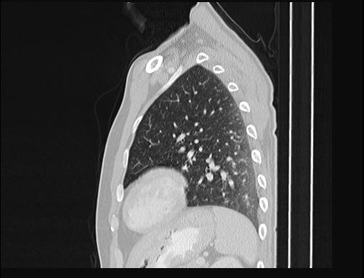 Addison disease (Radiopaedia 49318-54412 Sagittal lung window 16).jpg
