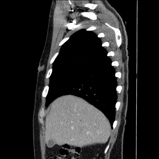 Adenocarcinoma of the lung (Radiopaedia 59871-67325 Sagittal C+ arterial phase 16).jpg