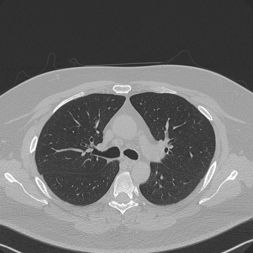 File:Adenoid cystic carcinoma of the trachea (Radiopaedia 49042-54137 Axial lung window 127).jpg