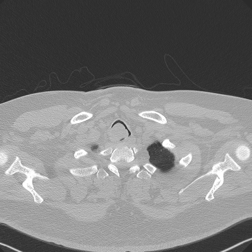 Adenoid cystic carcinoma of the trachea (Radiopaedia 49042-54137 Axial lung window 23).jpg