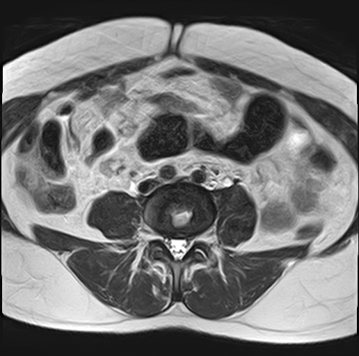 File:Adenomyosis - ovarian endometriomas (Radiopaedia 67031-76350 Axial T2 1).jpg