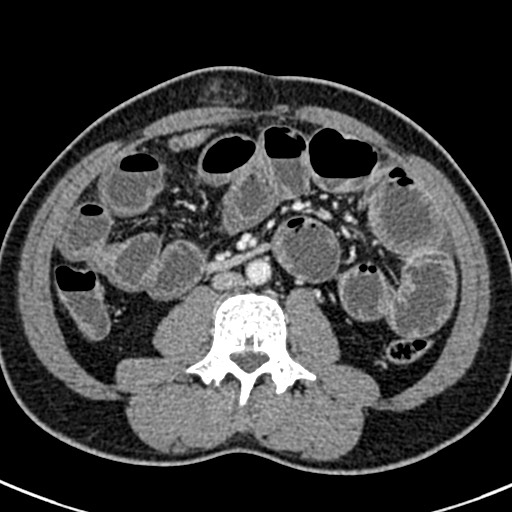 Adhesional small bowel obstruction (Radiopaedia 58900-66131 Axial C+ portal venous phase 27).jpg