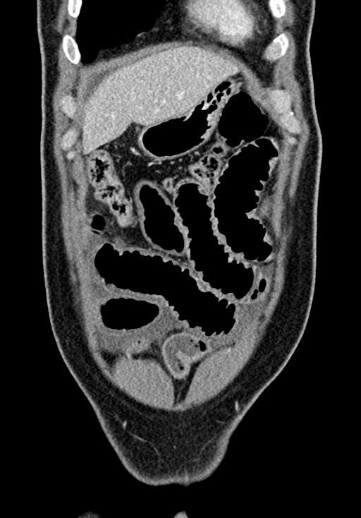 Adhesional small bowel obstruction (Radiopaedia 58900-66131 Coronal C+ portal venous phase 78).jpg