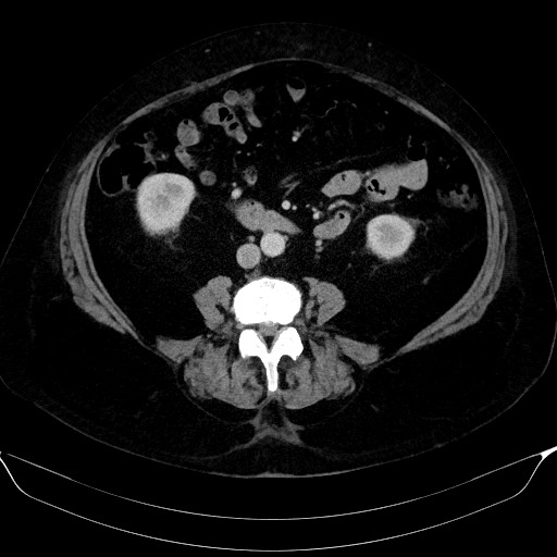 Adrenal cortical carcinoma (Radiopaedia 64017-72769 Axial C+ portal venous phase 39).jpg