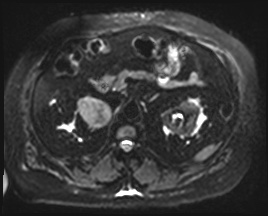 Adrenal cortical carcinoma (Radiopaedia 64017-72770 Axial DWI 20).jpg