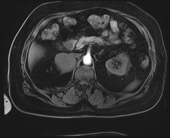 Adrenal cortical carcinoma (Radiopaedia 64017-72770 Axial T1 C+ fat sat 15).jpg